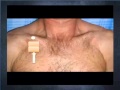 Chest Decompression