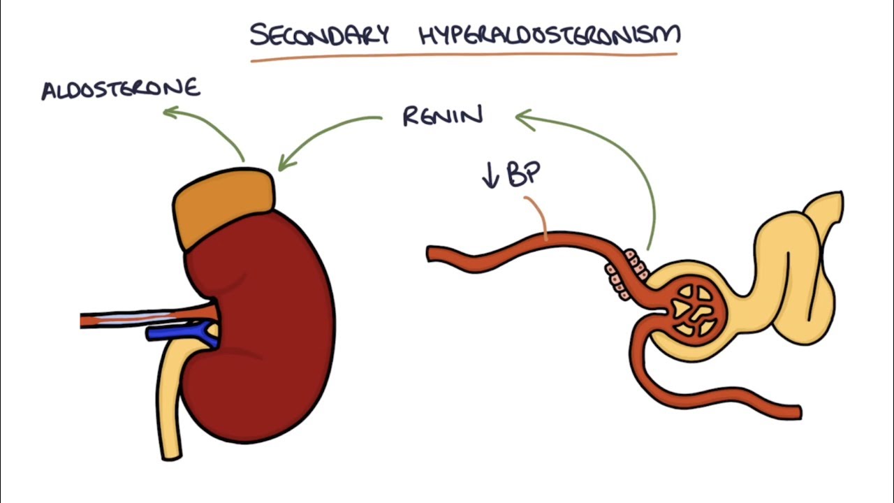 Primärer Hyperaldosteronismus - Conn Syndrom