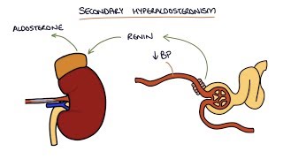 Hyperaldosteronism and Conn's Syndrome