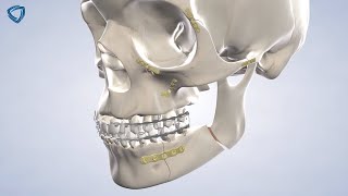 Facial Trauma at Columbia Basin Oral & Maxillofacial Surgeons