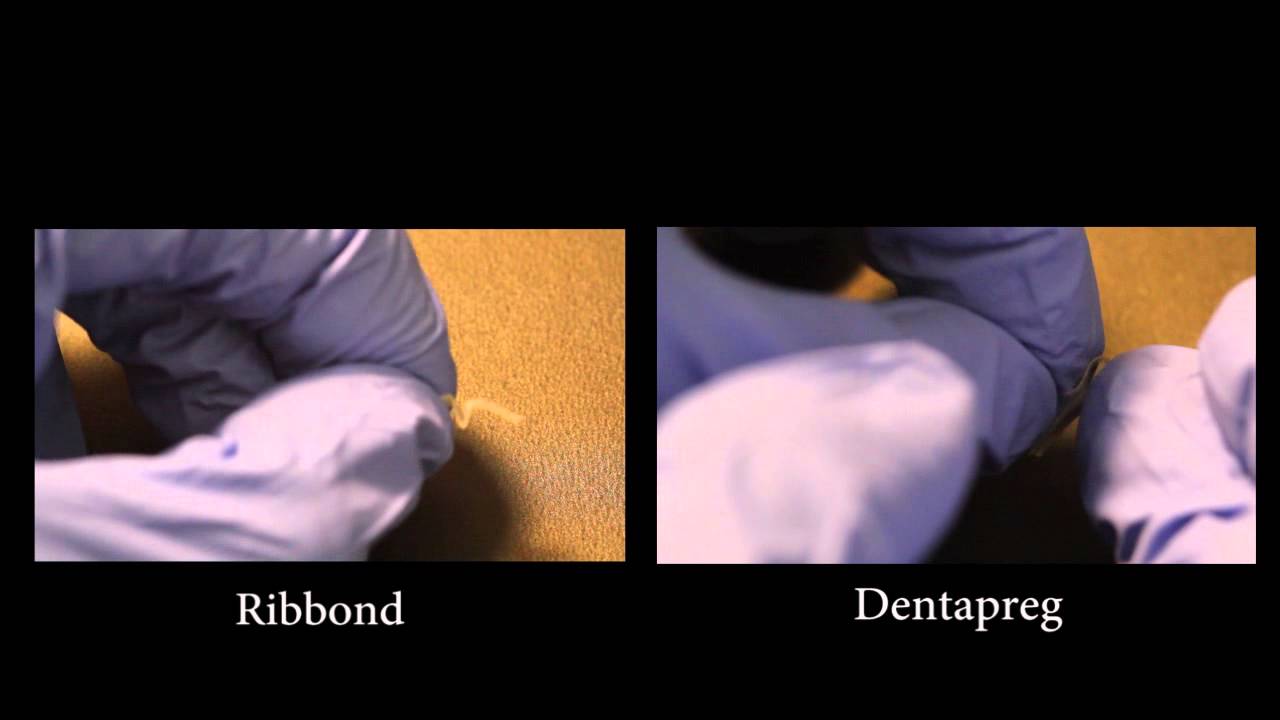 Ribbond vs Dentapreg