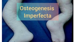 Osteogenesis Imperfecta | brittle bone disease in hindi | Learn with fun - bone disease in infants