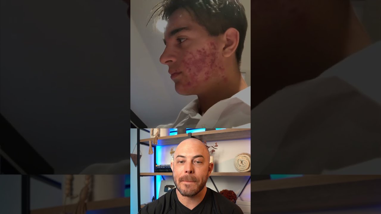 Derm Reacts To Unbelievable Acne Transformation Dermreacts Doctorreacts Accutane