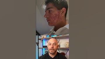 Derm reacts to unbelievable acne transformation! #dermreacts #doctorreacts #accutane