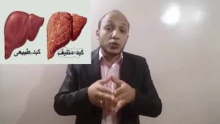 أعراض تليف الكبد _ clinical picture of liver cirrhosis