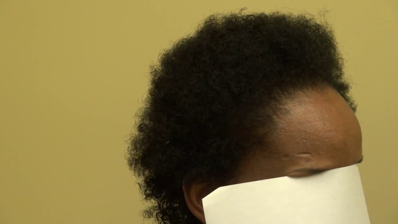 Advance Hair Loss Black Woman Bad Hair Loss Surgery Treatment Dr. Diep