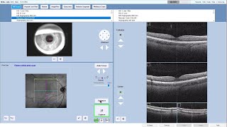 How to take a Macular scan and HD Raster scan on the ZEISS CIRRUS 6000 screenshot 3