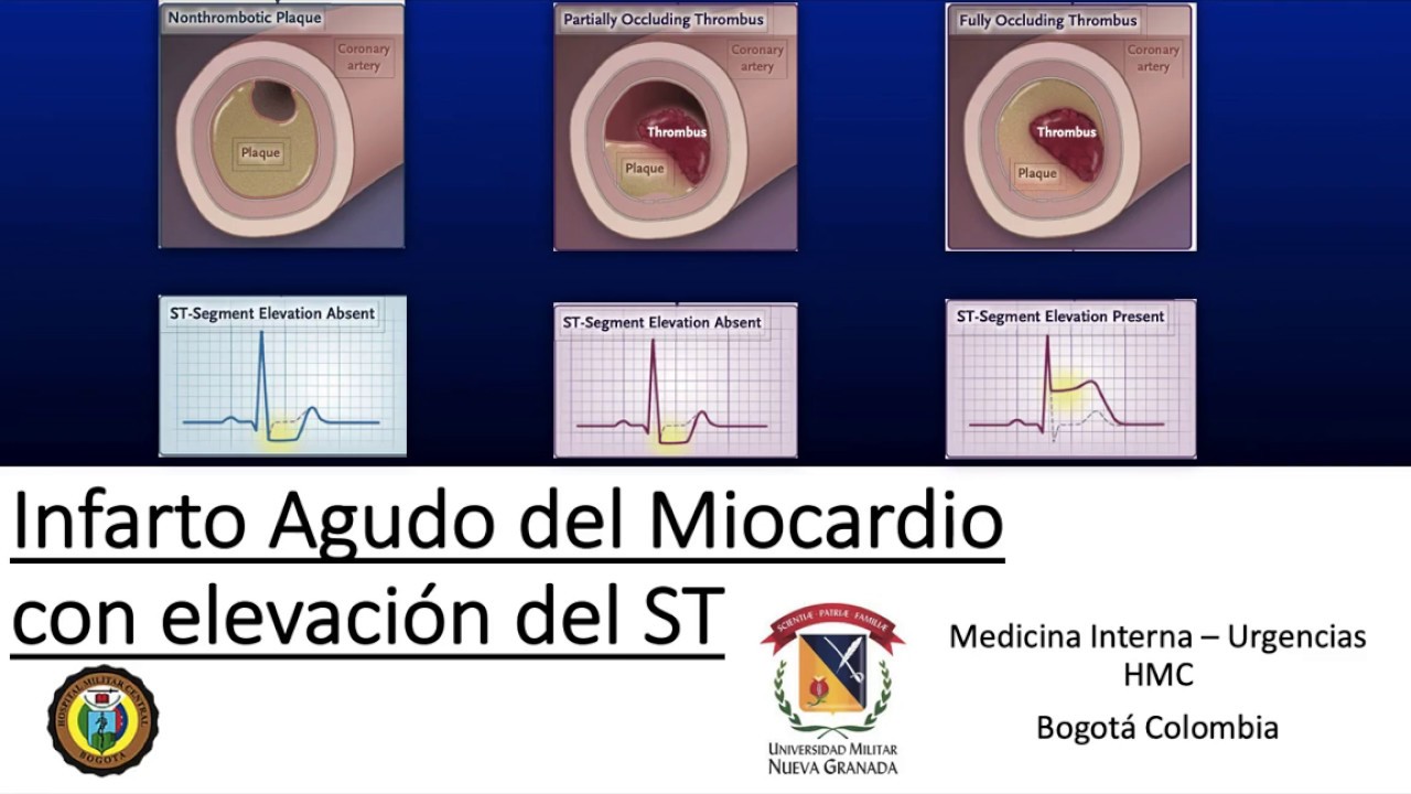 Infarto agudo del miocardio con elevación del ST, PARTE 1, (IAMCEST)