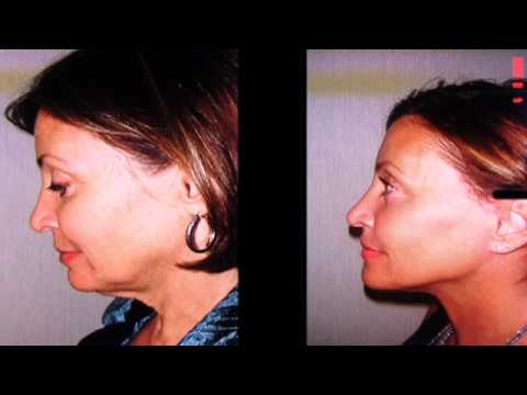 Video thumbnail: Best Facelift Surgeon in New York · Dr. Sam Rizk