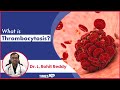 Thrombocytosis  high platelet count symptoms conditions  treatment procedures  timesxp