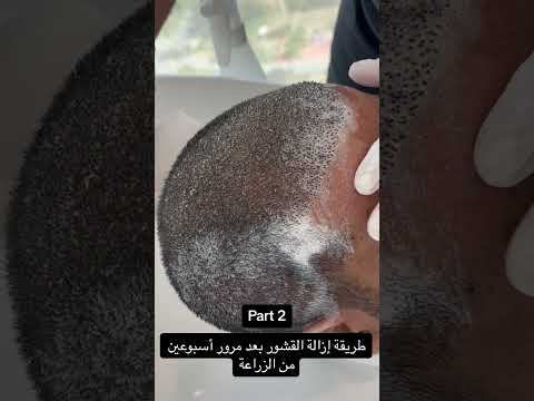 طريقة إزالة القشور مرور أسبوعين من الزراعة ايدن الخالدي اكسبلور زراعة ترند زراعة شعر