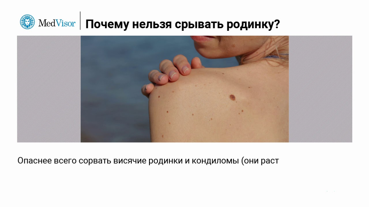 Почему нельзя срывать родинку?