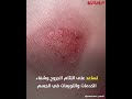 الألوفيرا بين الفوائد والأضرار