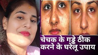 चिकन पॉक्स या चेचक के निशान कैसे हटाये | Chechak Ke daag aur gadde ka ilaj | scars / smallpox