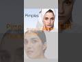 "Pimples or Melasma ko हटाओ घर बैठे 🚀 | Passo Bem Solto Trending Reels Song | Acne Treatment"