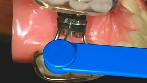 How to turn an RPE (Rapid Palatal Expander) : Nirenblatt Orthodontics