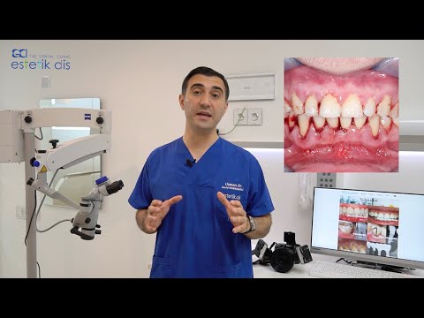Video: Qırmızı və iltihablı diş ətlərini sakitləşdirməyin 4 yolu