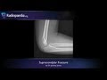 Supracondylar fracture - radiology video tutorial (x-ray)