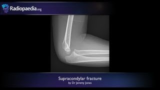 Supracondylar fracture - radiology video tutorial (x-ray)