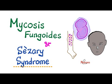 Video: Můžete zemřít na mycosis fungoides?