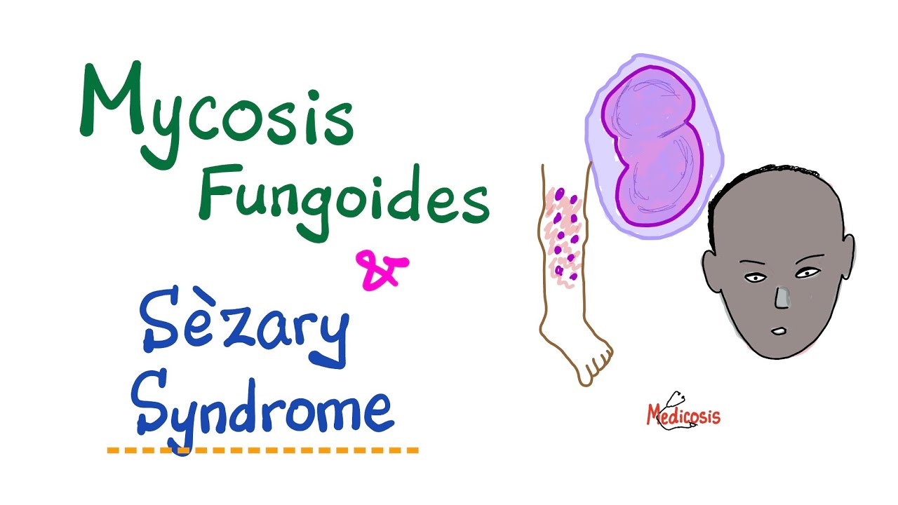 HPV fertőzés - Humán papillomavírus mycosis