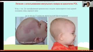 Мальформация кровеносных сосудов у детей на лице, голове  и шее
