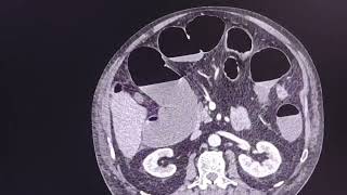 Large bowel obstruction - colonic tumour - step by step approach - Radiologist's point of view