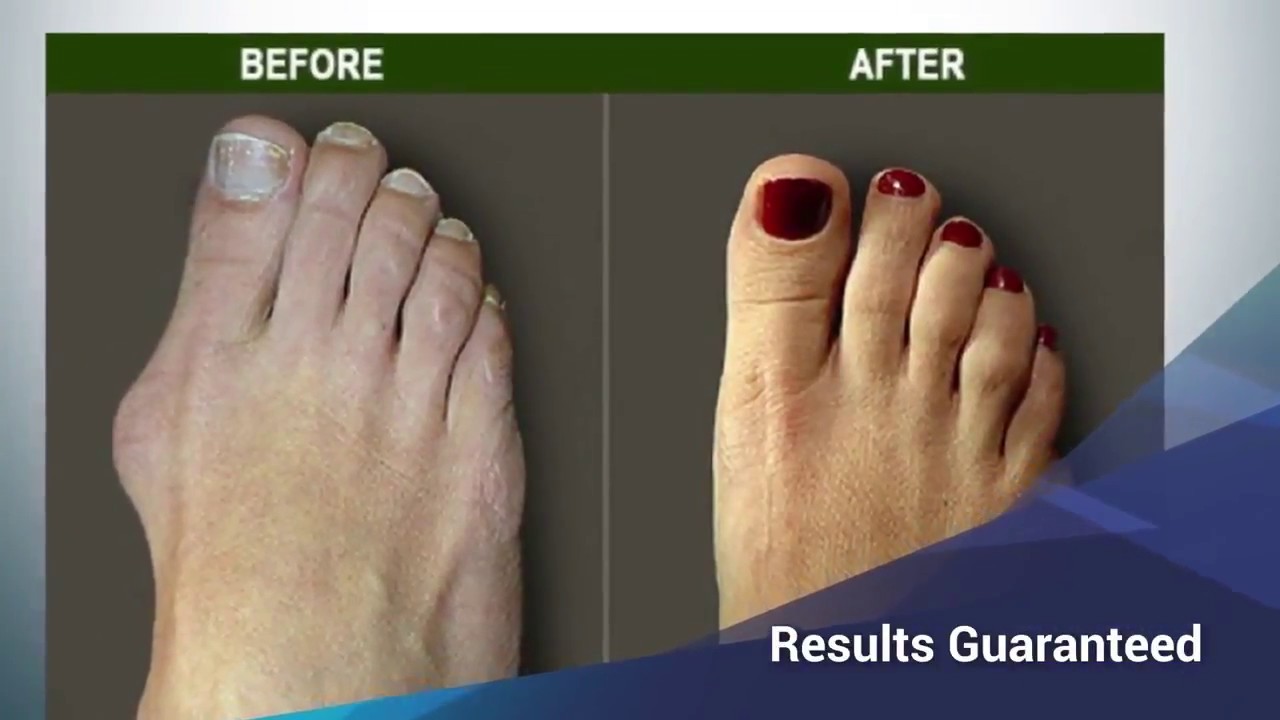 Bunion Corrector Before And After : Before & After Bunion Surgery Photo