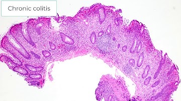 Histologic Diagnosis of Chronic Colitis