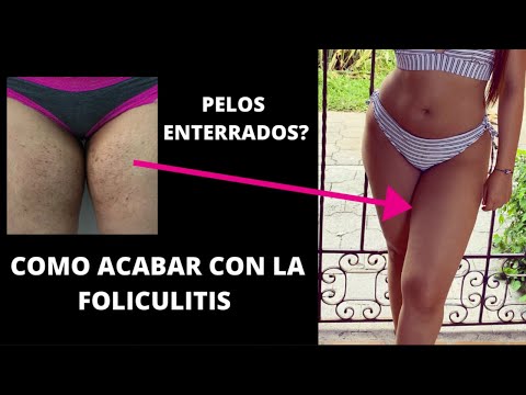 Vídeo: Pseudofoliculitis: Cómo Deshacerse De Los Pelos Encarnados En El área Del Bikini, En Las Piernas, En El Cuerpo