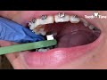 Expander removal - Braces Checkups - Tooth Time Family Dentistry New Braunfels