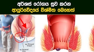 අර්ශස් සුව කරන ආයුර්වේදයේ විශ්මිත බෙහෙත් | Arshas | Ayurvedic Treatment | 2022.03.15