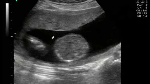 Gina LaBarbera's 17 week ultrasound Part 1