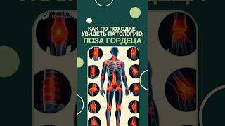 Как по походке заметить патологию