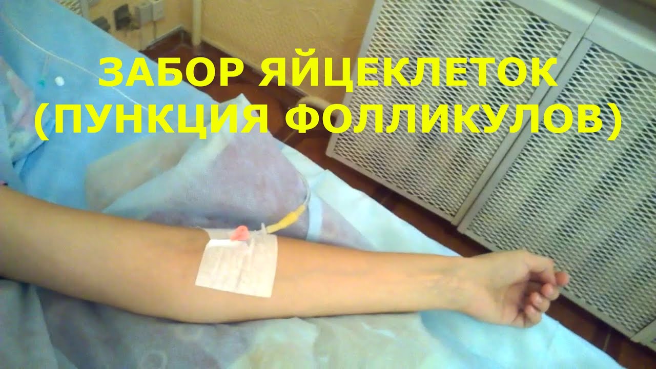 ЭКО. Часть 1: забор яйцеклеток, пункция фолликулов - YouTube