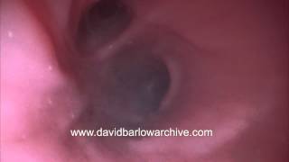 Bronchii in the Lung by David Barlow 2,086 views 9 years ago 1 minute, 19 seconds