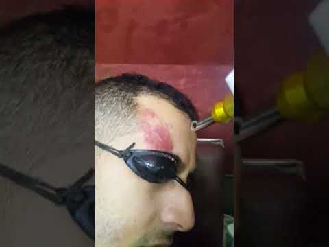 أحدث علاج بالليزر للوحمات الوحمة الدموية بالليزر NDYAG LASER Haemangioma الليزر الوحمات الدموية 