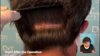 Long Hair (non-shaved) FUE Operation by Dr. Tayfun Oguzoglu at DrT Hair Transplant Clinics