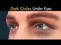 What Causes Dark Circles Under Eyes? | Symptoms, Causes And Treatment of Dark Circles Under Eyes