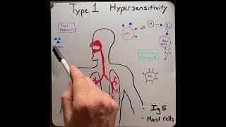 Type I hypersensitivity reaction in 2 mins!