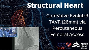 CoreValve Evolut-R TAVR (26mm) via Percutaneous Femoral Access - August 2015 Structural Live Case