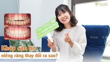 Khớp cắn hở niềng răng thay đổi ra sao? - KH Nguyễn Thị Thanh Huyền Hn5389