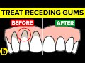 How To Treat Your Receding Gums At Home Naturally