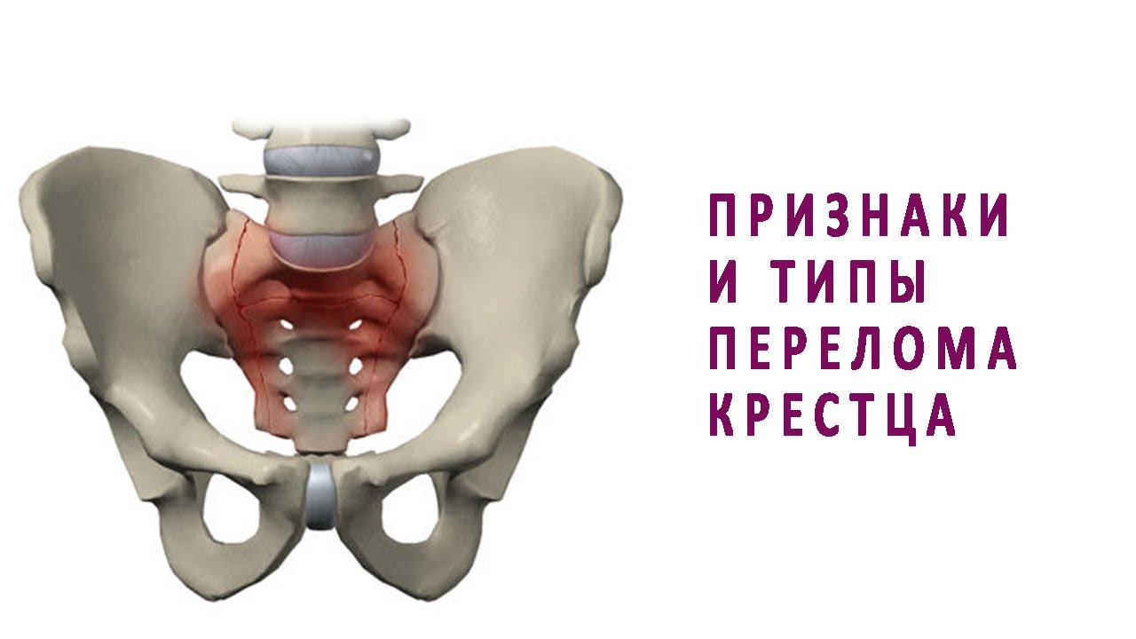 Трещина крестца. Осколочный перелом крестца. Вертикальный перелом крестца.