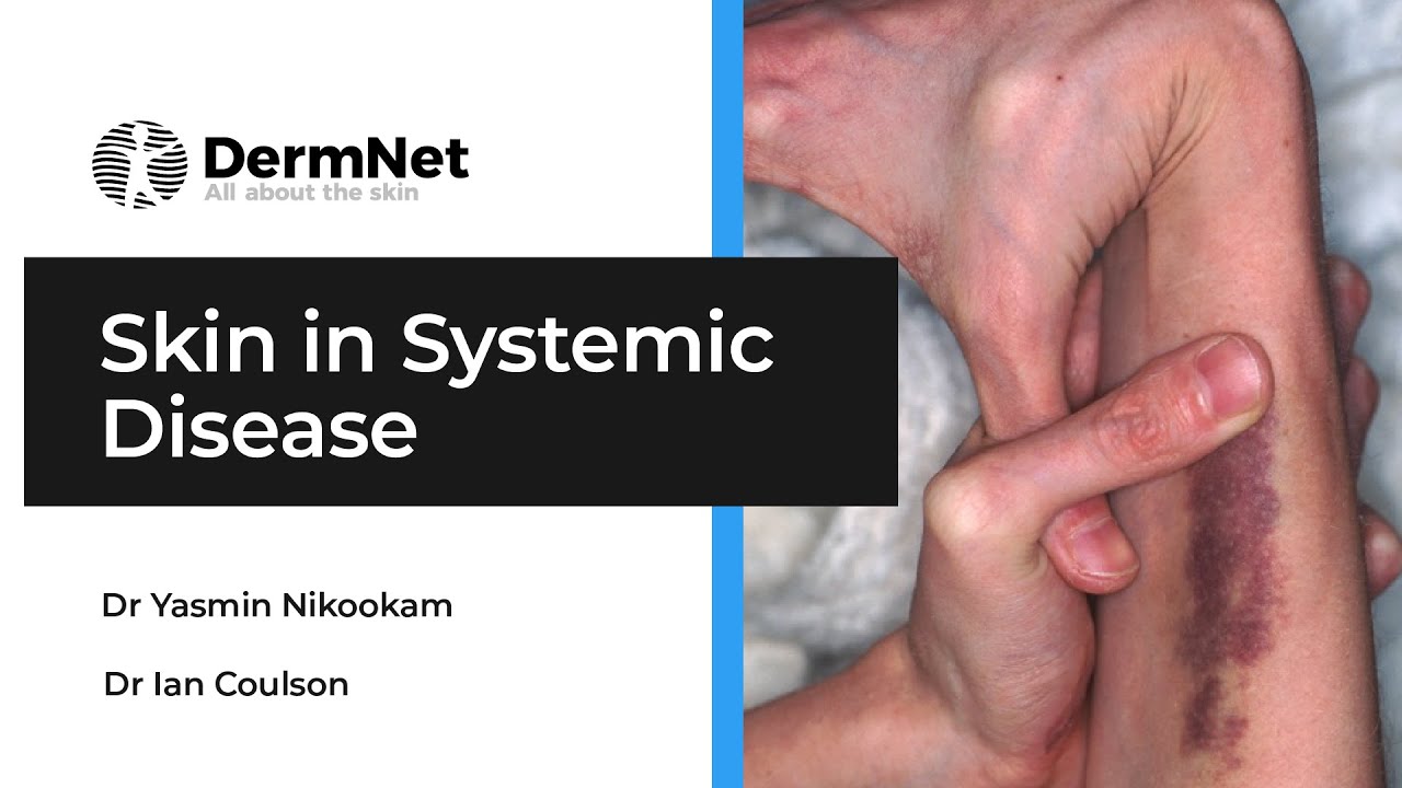 健康・医学 SKIN AND SYSTEMIC DISEASE Skin Signs of Systemic Disease | Amazon.com.br