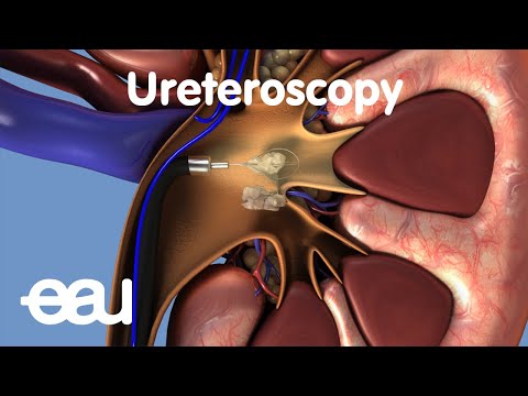 Video: Ureter Stone: Příznaky, Léčba A Prevence