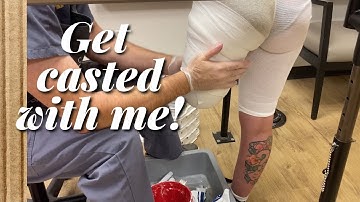 AK Amputee getting first cast for prosthetic socket