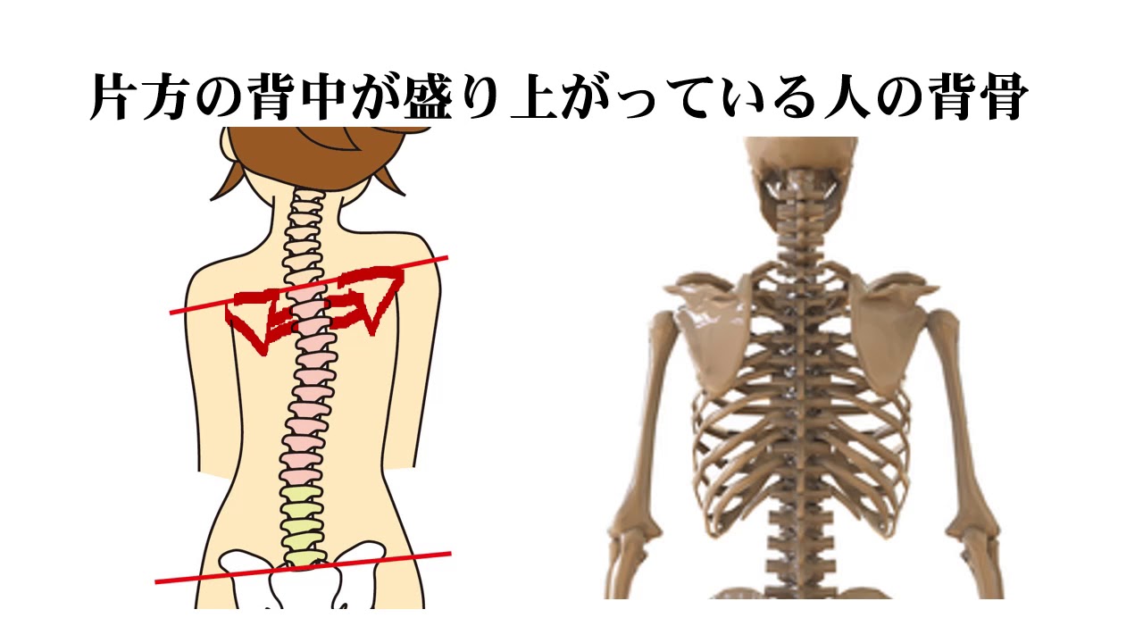 背中 の 盛り上がり 原因