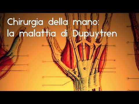 Chirurgia della Mano: Malattia di Dupuytren