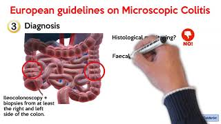 European guidelines on microscopic colitis: UEG and EMCG statements and recommendations. 2020